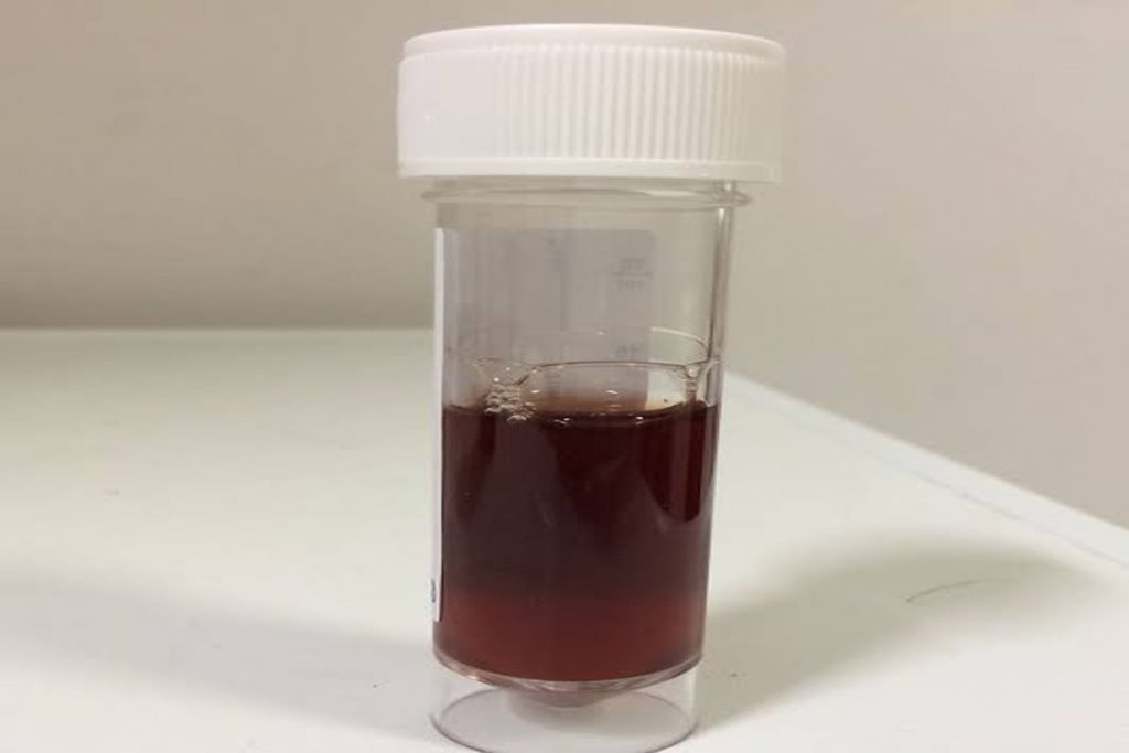 dark brown urine 3 1