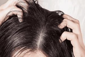 Ayurvedic Herbs for Dandruff Treatment