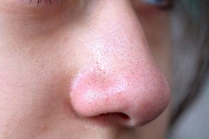 blackheads