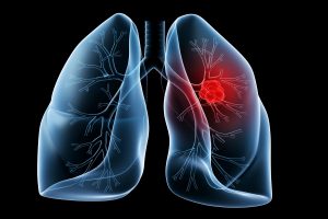 lung cancer