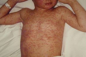 measles disease