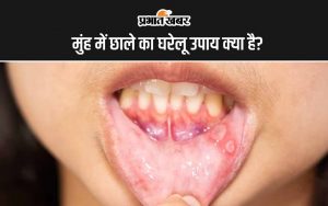 Mouth Ulcers