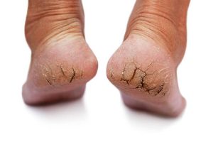 Painful cracked heels remedy