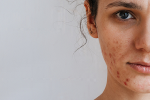 Top 5 Foods That May Cause Acne