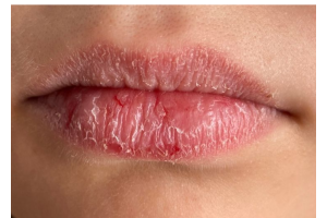 3 Home Remedies for Dry lips: फटे होंठों से पाएं छुटकारा जानें 3 आसान घरेलू उपाय