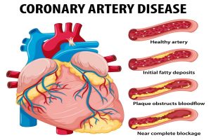 heart disease and cholestrol