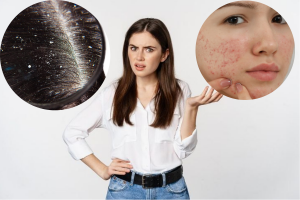 Oily scalp and dandruff can cause acne: ऑइली स्कैल्प और डैंड्रफ भी हो सकते हैं ऐक्ने का कारण