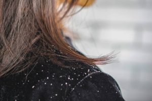 cure for dandruff