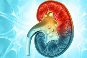 Prevention of Kidney Stone